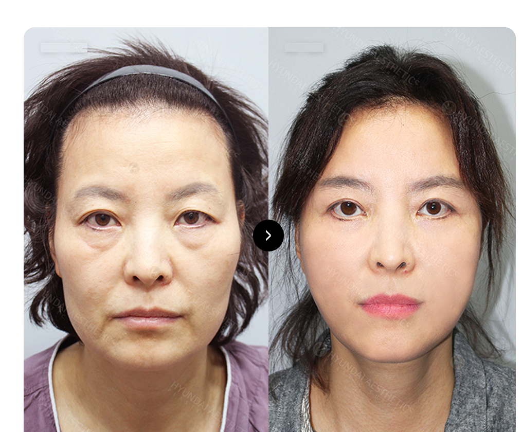 SMAS facelift BEFORE & AFTER — perbandingan sebelum dan sesudah operasi