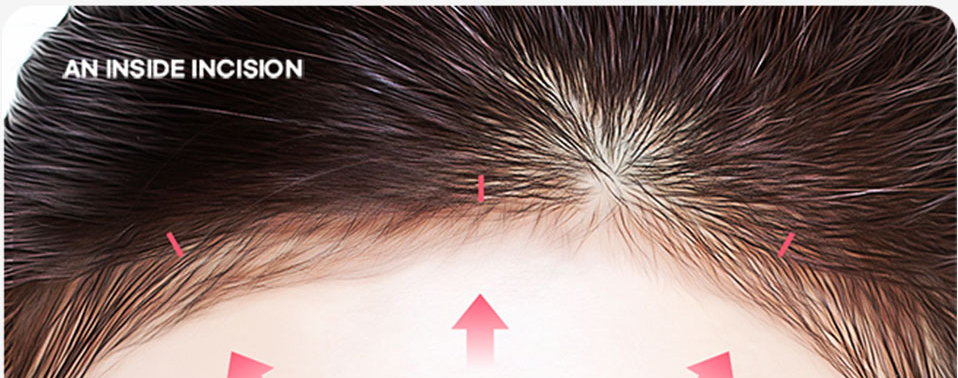 Tampilan dekat dahi yang menunjukkan area sayatan di dalam garis rambut — AN INSIDE INCISION