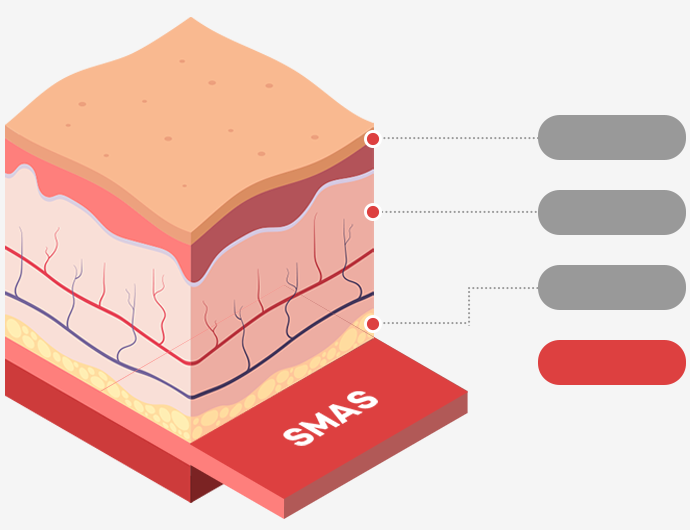 Ilustrasi penampang kulit yang menunjukkan lapisan epidermis, dermis, lemak subkutan, dan SMAS