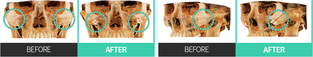 CASE 02 Reposisi posterosuperior — perbandingan CT tampak depan·samping BEFORE / AFTER