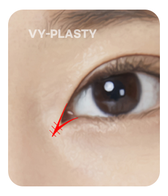Ilustrasi V-Y plasty