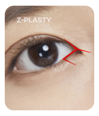 Ilustrasi Z-plasty