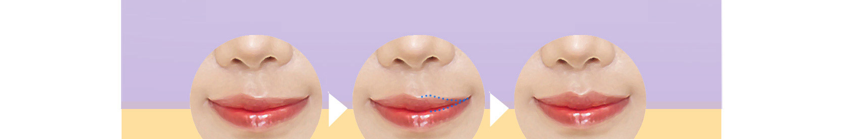 Sebelum & sesudah koreksi asimetri puncak bibir / garis bibir