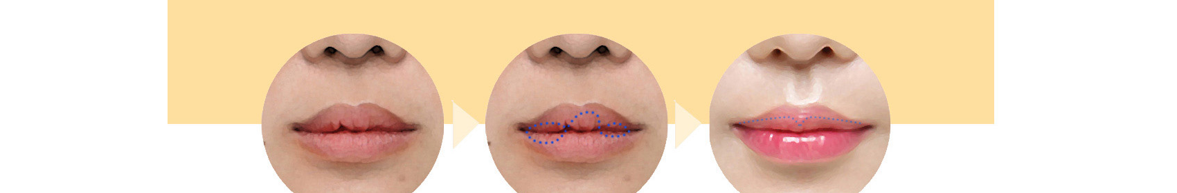 Sebelum & sesudah koreksi asimetri mukosa bibir