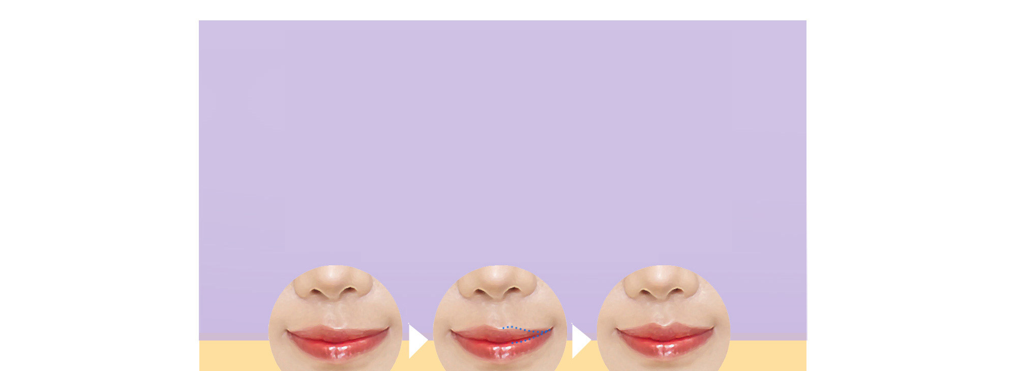 Koreksi Asimetri Cupid's Bow / Garis Bibir