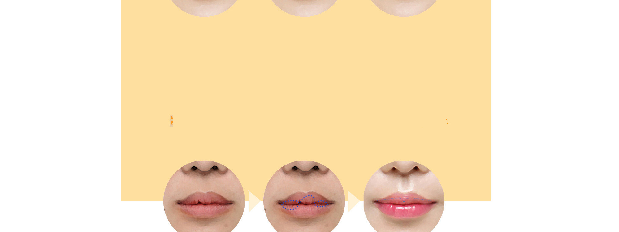 Koreksi asimetri mukosa bibir