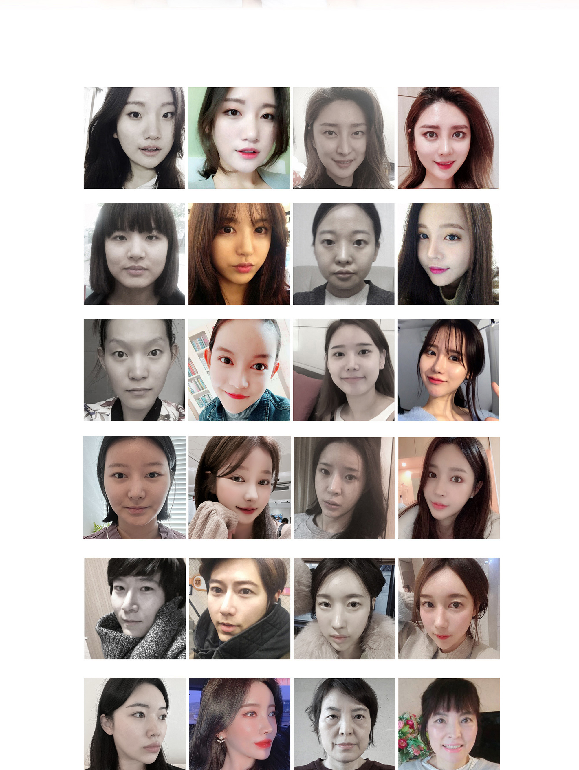 Kasus Before & After Operasi Koreksi Asimetri Bibir