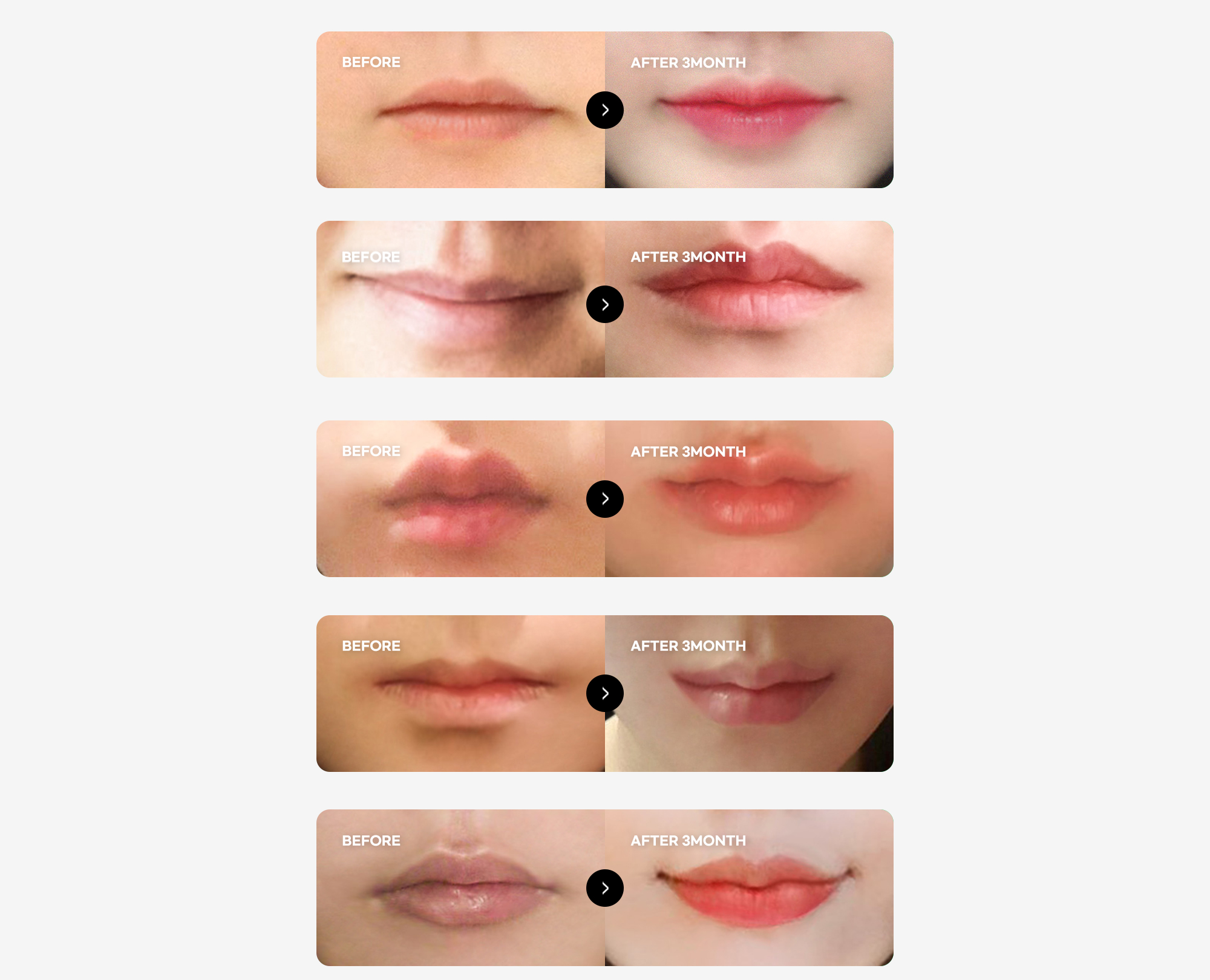 Kasus operasi bibir Cupid Line BEFORE & AFTER