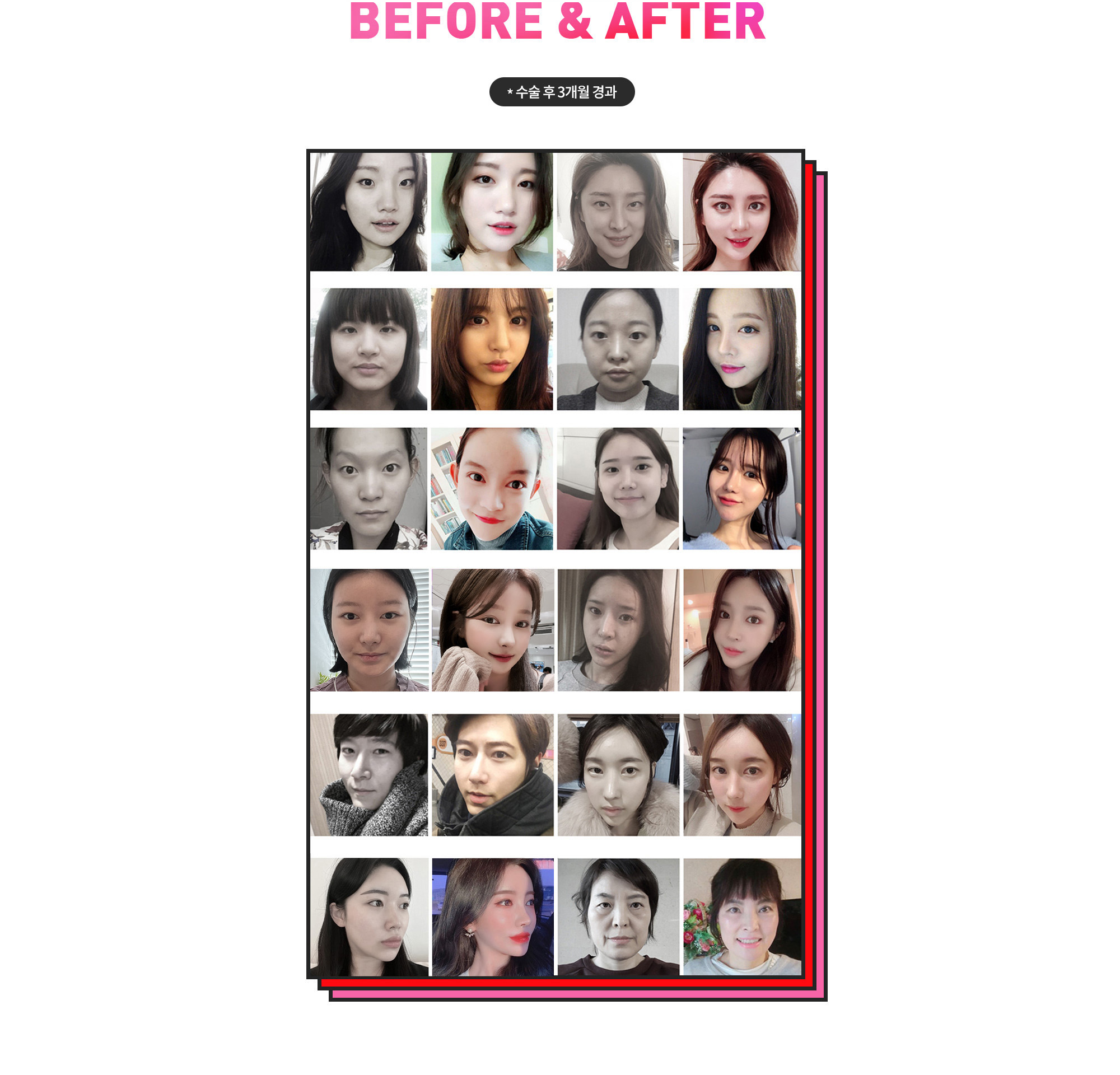 Sebelum dan Sesudah Operasi Plastik Bibir Hyundai Aesthetics