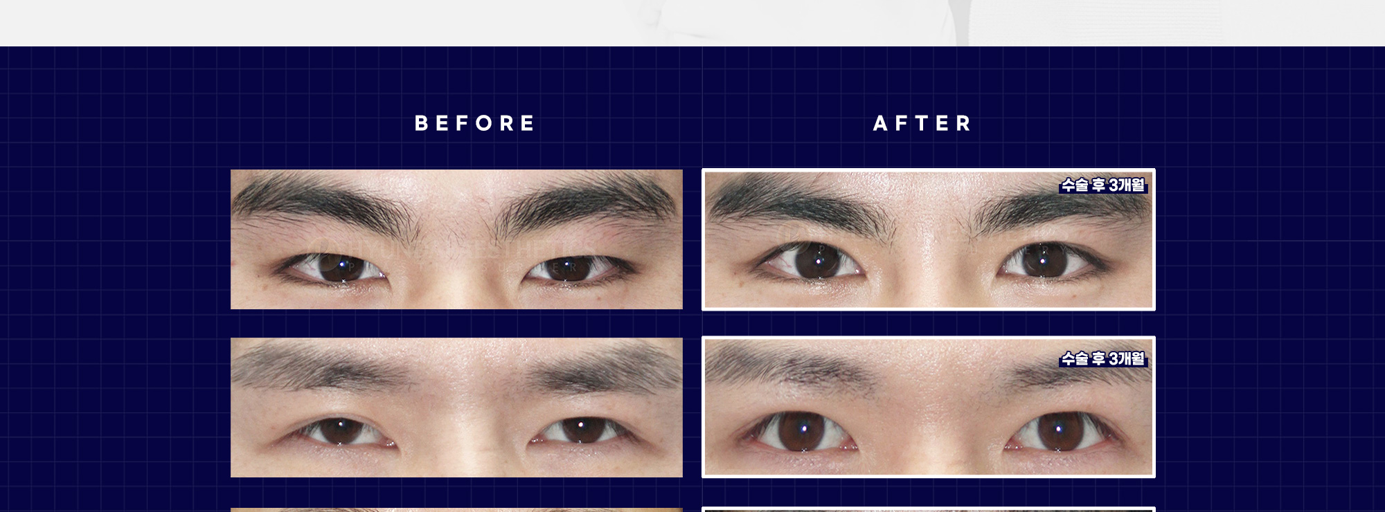 Operasi Mata Pria BEFORE & AFTER — 3 bulan setelah operasi