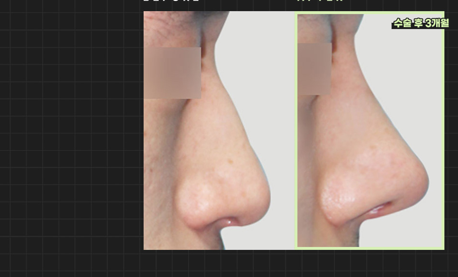 Foto Sebelum dan Sesudah Operasi Hidung Pria Hyundai Aesthetics