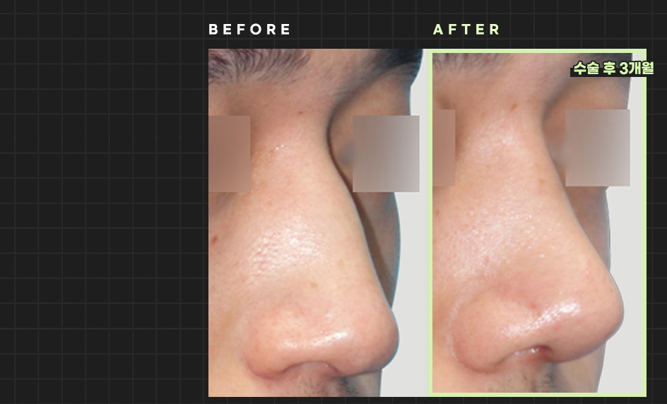 Foto Sebelum dan Sesudah Operasi Hidung Pria Hyundai Aesthetics