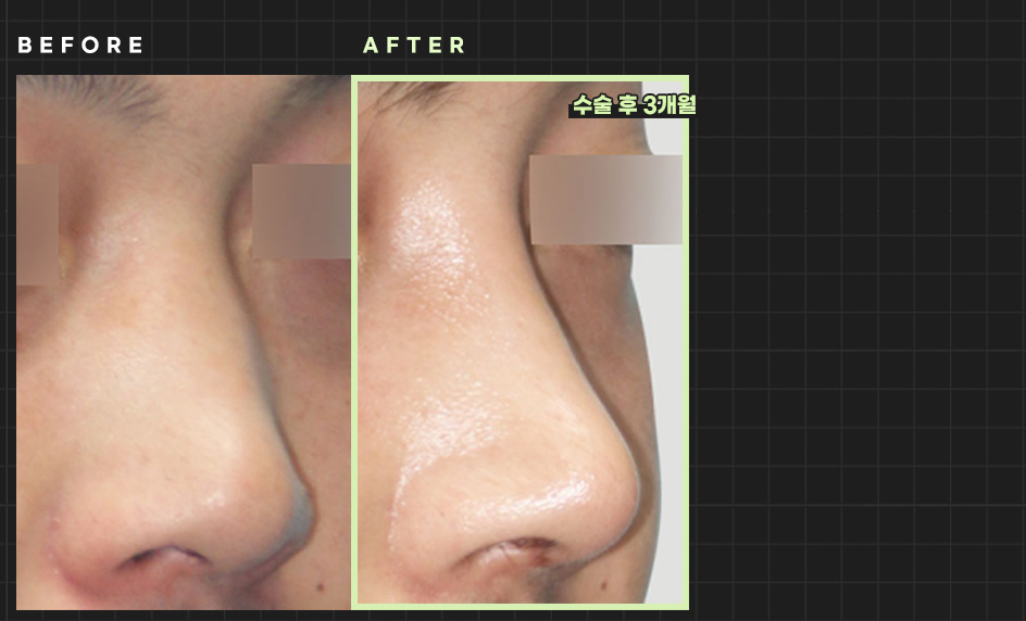 Foto Sebelum dan Sesudah Operasi Hidung Pria Hyundai Aesthetics