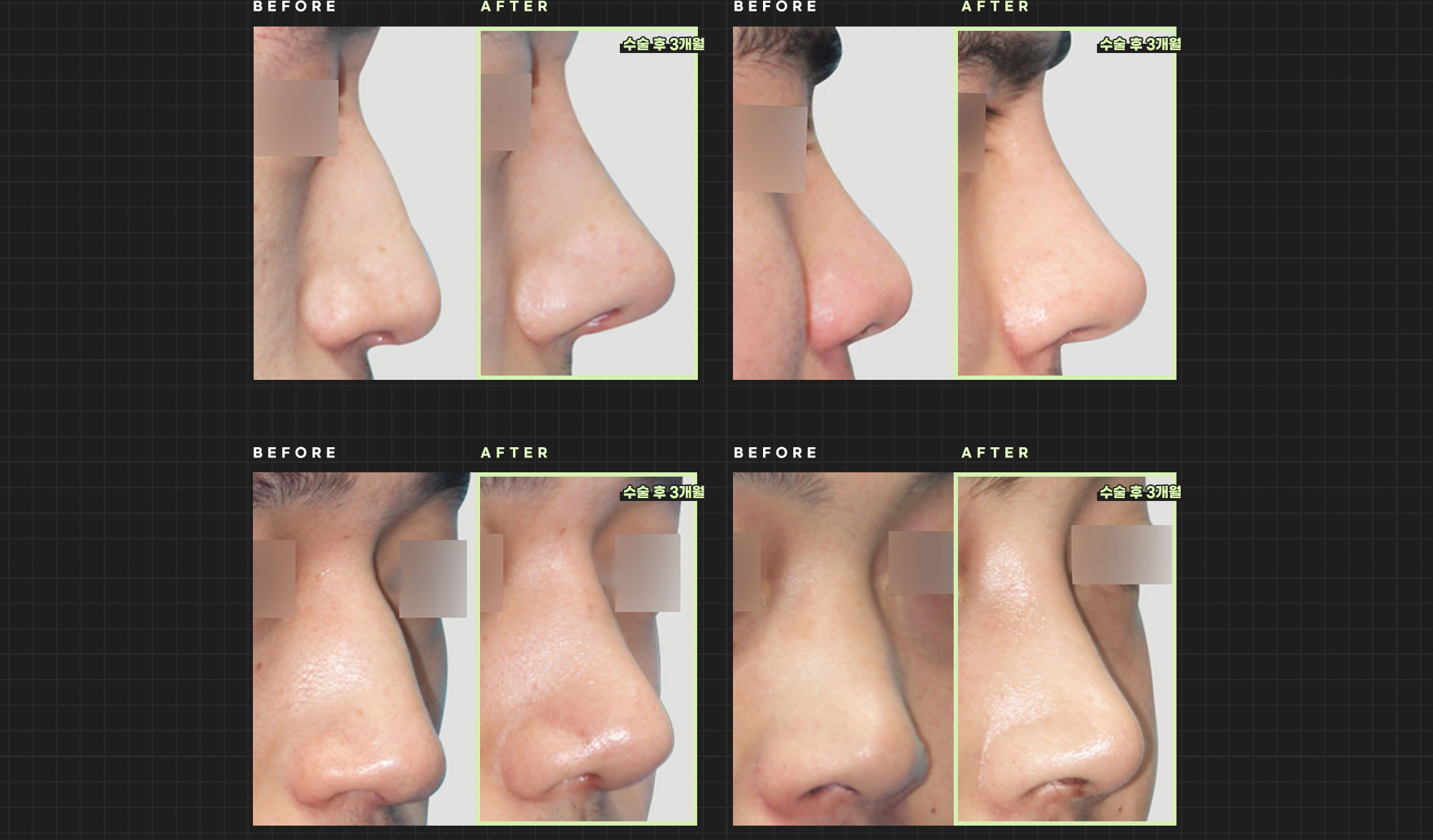 Foto sebelum dan sesudah operasi hidung pria Hyundai Aesthetics