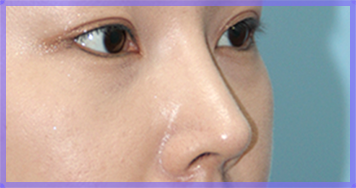 Setelah operasi hidung panah — Foto hidung dari samping (AFTER)