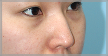 Sebelum operasi hidung panah — Foto hidung dari samping (BEFORE)