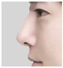 Kasus tampak samping hidung bengkok 1