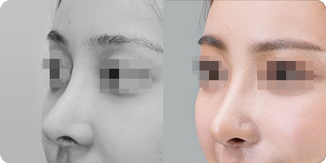 Perbandingan tampak samping sebelum dan sesudah operasi hidung tanpa implan 1 (BEFORE / AFTER 3MONTH)