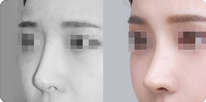Perbandingan tampak samping sebelum dan sesudah operasi hidung tanpa implan 2 (BEFORE / AFTER 3MONTH)