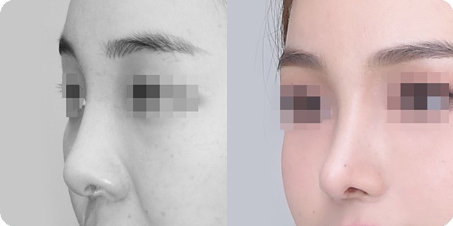 Perbandingan tampak samping sebelum dan sesudah operasi hidung tanpa implan 3 (BEFORE / AFTER 3MONTH)