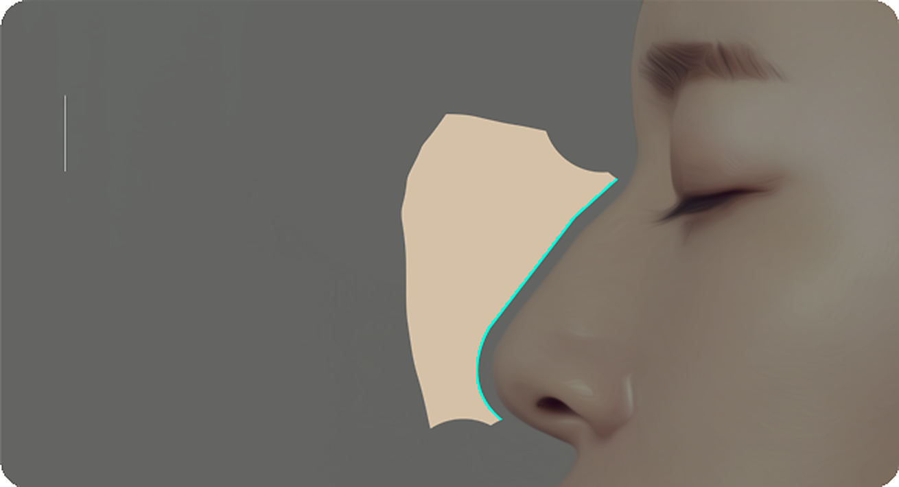 Tampak samping hidung pada kasus dengan ketinggian pangkal hidung yang proporsional dan ujung hidung tinggi