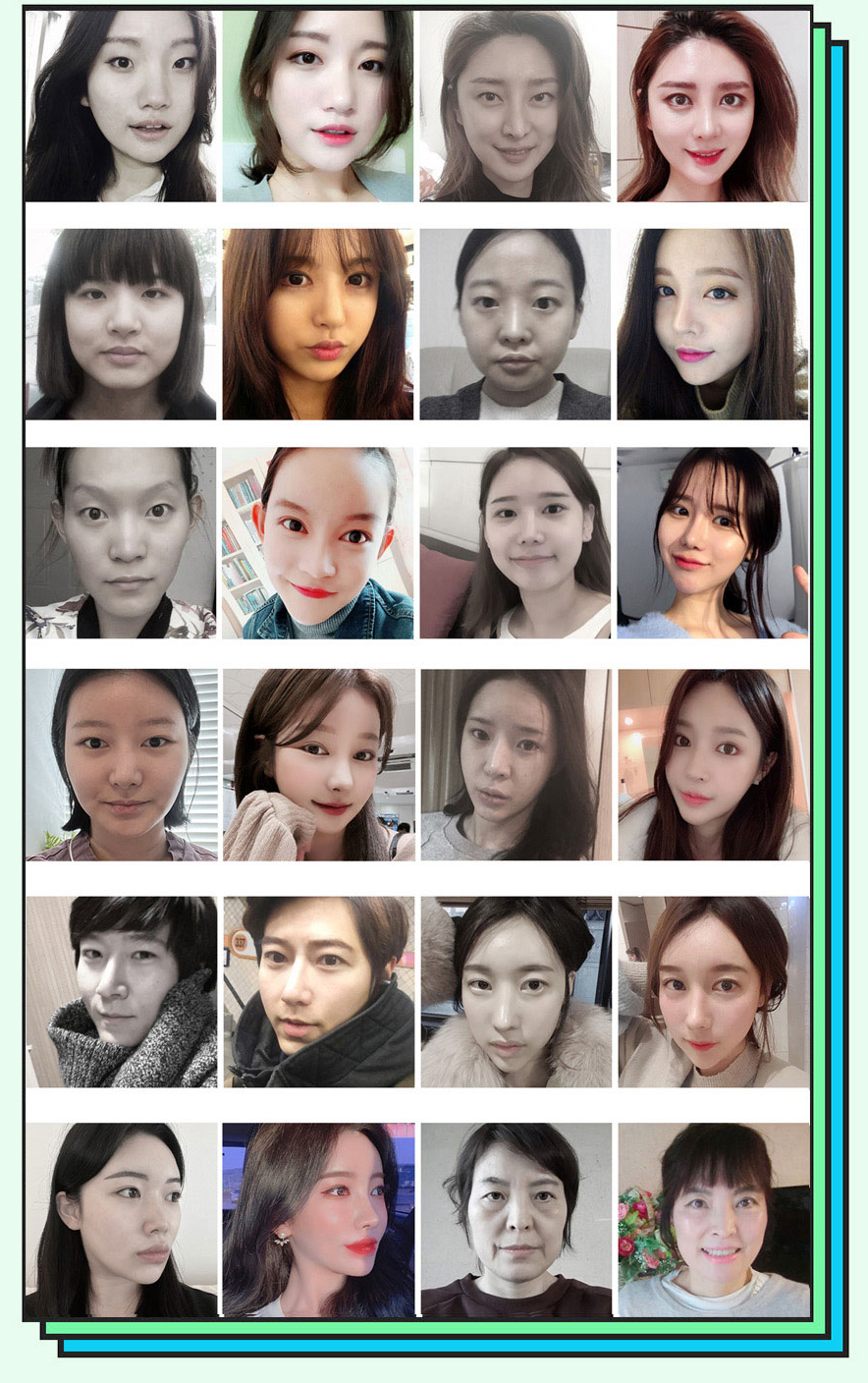 Foto perbandingan sebelum dan sesudah operasi hidung bengkok Hyundai Aesthetics
