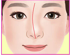 Ilustrasi hidung bengkok tipe C