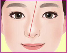 Ilustrasi hidung bengkok tipe diagonal