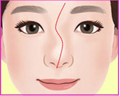 Ilustrasi hidung bengkok tipe S
