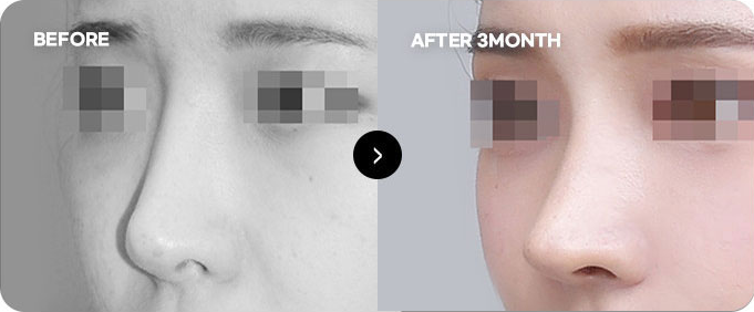 Sebelum dan sesudah koreksi ulang garis batang hidung tinggi 1