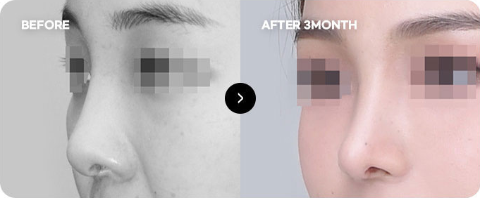 Sebelum dan sesudah koreksi ulang garis batang hidung tinggi 2