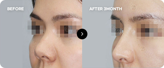 Sebelum dan sesudah operasi revisi kontraktur hidung 1