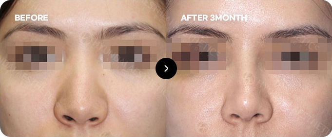 Sebelum dan sesudah operasi revisi kontraktur hidung 2