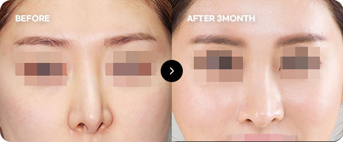 Sebelum dan sesudah koreksi ulang hidung yang bengkok akibat operasi & perlekatan kulit 1