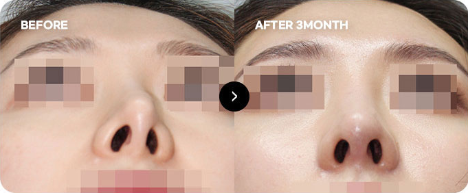 Sebelum dan sesudah koreksi ulang hidung yang bengkok akibat operasi & perlekatan kulit 2