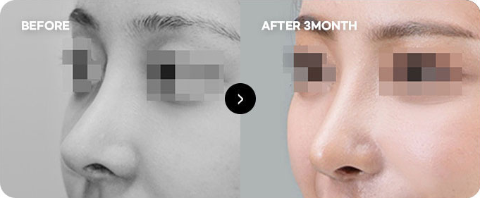 Sebelum dan sesudah koreksi ulang garis ujung hidung 1