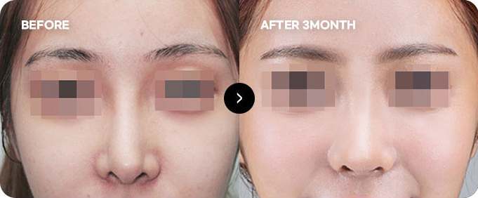 Sebelum dan sesudah koreksi ulang garis ujung hidung 2